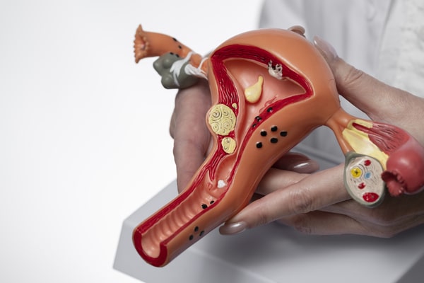 Modelo anatómico de útero con lesiones de endometriosis para explicación en consulta
