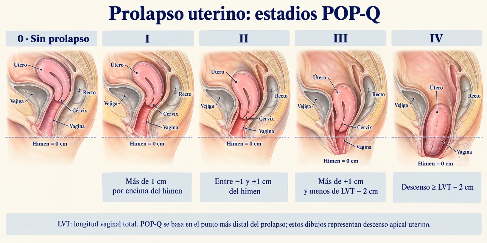 Ilustración de los cinco estadios del prolapso uterino según la Cuantificación del Prolapso de Órganos Pélvicos (POP-Q), con el himen como punto de referencia